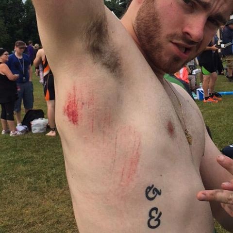 A photo of my scraped side after the fall
